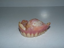 Ancien dentier prothèse