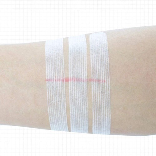Wound skin closure - wound, strips