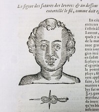 Chirurgie esthétique en 1614 Chirurgie du Nez Bouche Rare Gravure Ambroise Paré