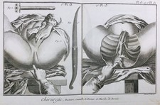 Gynécologue en 1779 Chirurgie Périnée Rare Gravure Médecine Encyclopédie Diderot