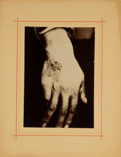 Doctor Bodin, medical photograph print d&#039;era 12x17 Circa 1