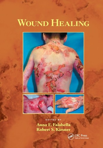 Anna falabella wound healing - anna,