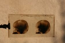antique 1928 Dalmasso Skull Glass Medical X-ray - R4