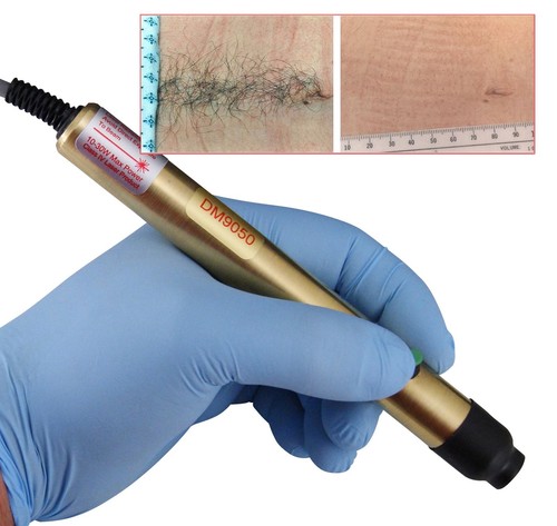 Permanent laser hair removal - laser,