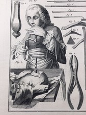Trépanation en 1779 Neurologie Chirurgie Gravure Médecine Encyclopédie Diderot