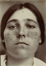 1906 Young Woman with Lupus Citrate Photograph by Dr. Bovin