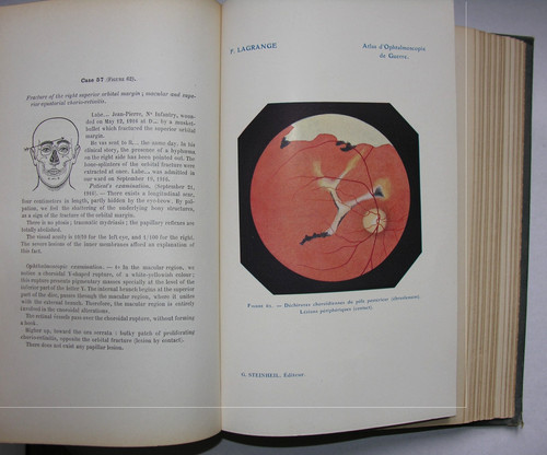 Atlas ophtalmoscopie de - atlas, d’ophtalmoscopie