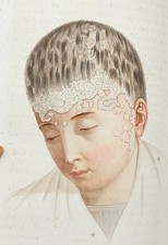 CAZENAVE TRAITÉ DES MALADIES