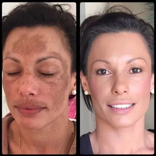 Gel mederma advanced - gel, scar