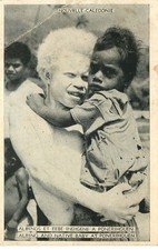NEW CALEDONIA albinos and indigenous baby in Ponerihouen NEW CALEDONIA