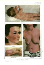 Cabinet of Curiosities Human Anatomy Measles Eruptions Book From