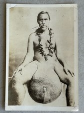 Photo Testicular Elephantiasis Medical Medicine Oceania Polynesia Hawaii Japan